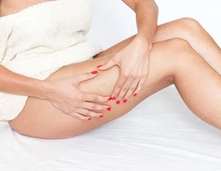 cellulite