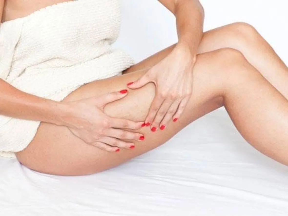 cellulite